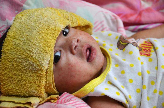Baby with measles
